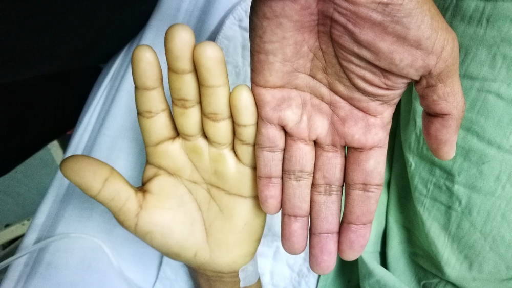 blood test, anaemia, anaemic sufferer, blood tests